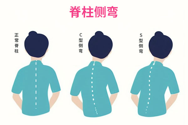 脊柱侧弯