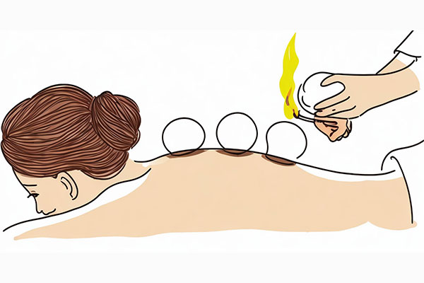 中医拔罐,拔罐误区,拔罐正确操作,万象城AWC888